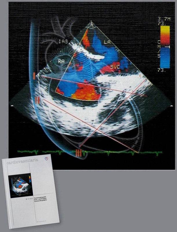Wissenschafts-Grafik: Transösophageale Echo/Doppler-Kardiographie